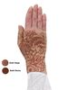 Bodhi Lymphoedema Gauntlet